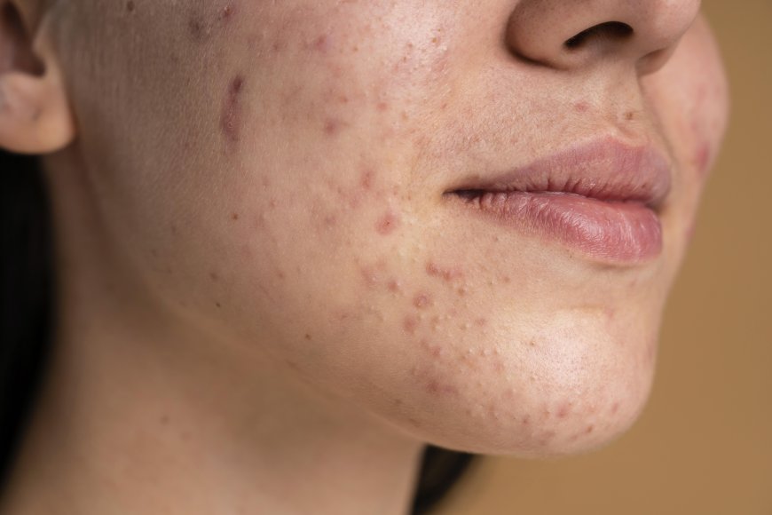 चेहरे पर पिंपल्स को कैसे हटाएं – आसान घरेलू और आयुर्वेदिक उपाय